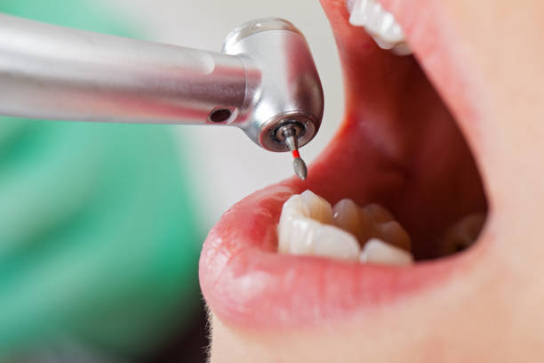 Best Knocked-Out Tooth (Avulsed Tooth) Treatment in Bayou La Batre, AL